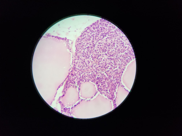 Parathyroid Thyroid Slides - Parathyroid_Thyroid 013 400X